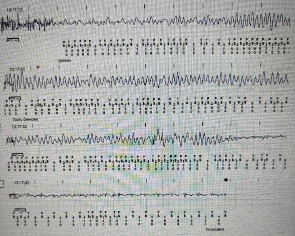 What’s the report say ?
- Sinus rhythm with noise 
- Noise - Ventricular arrhythmia self terminating to SR 

No symptoms reported.
Implanted for unexplained syncope.
No other cardiac issues.