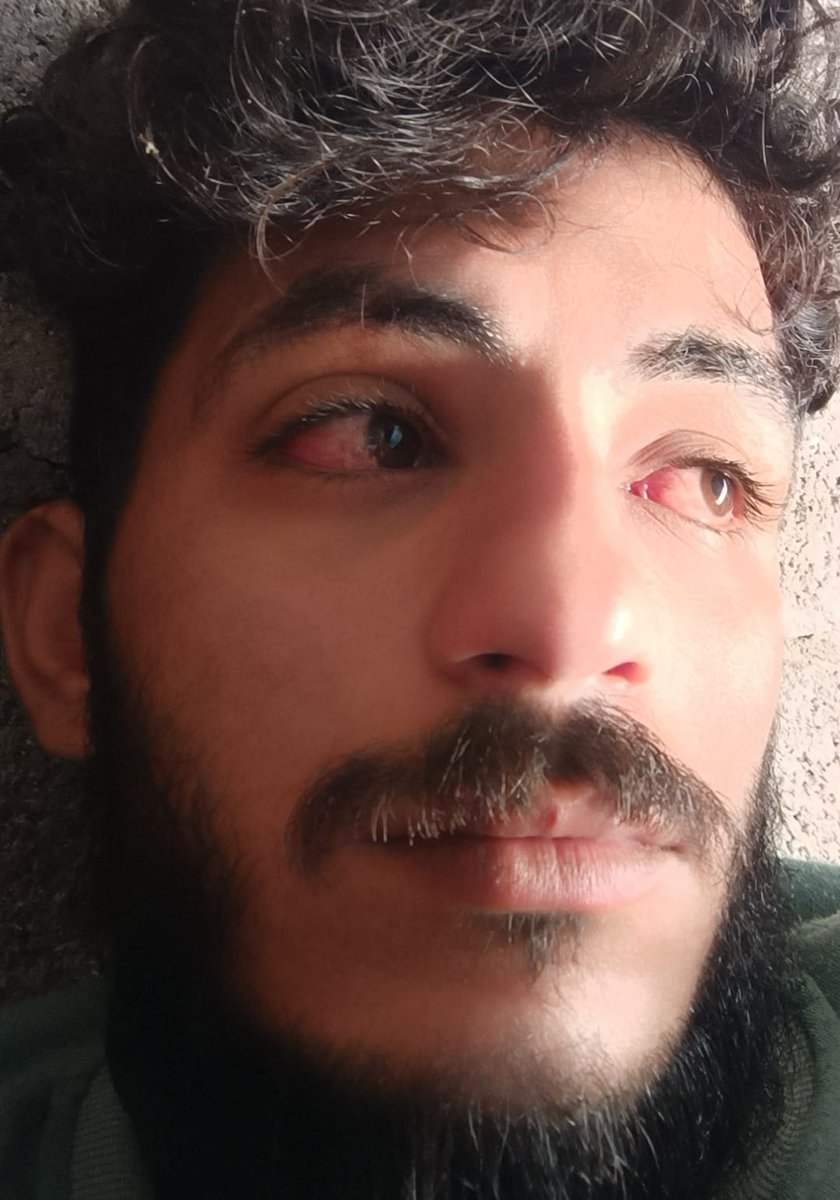 As you can see, I have had an infection for 3 days and a fever in my body.💔
Please stand with me so I can buy eye drops and help. 💔
Don't ignore me, I need you 💔
gofund.me/aaf6f599