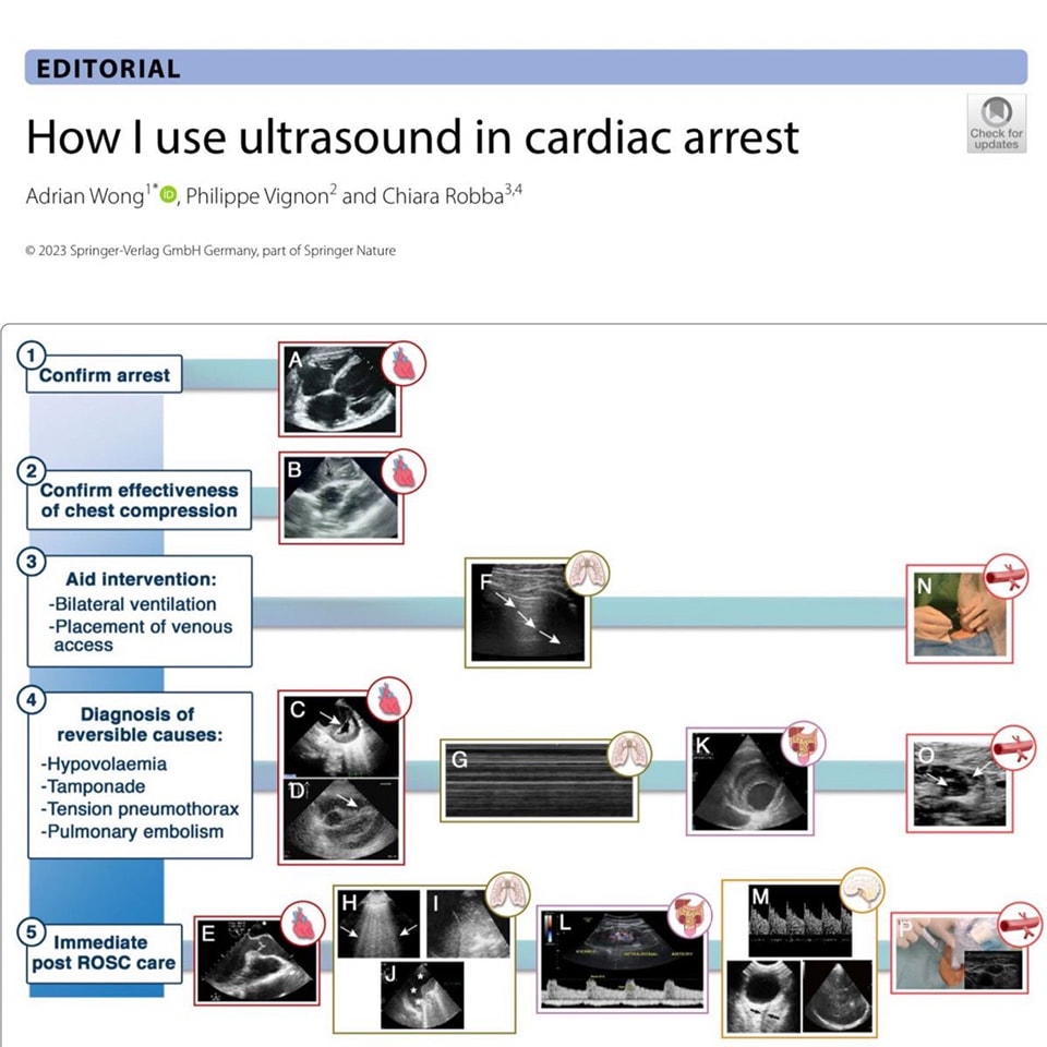 🔴How I use ultrasound in cardiac arrest ⤵️ #2023review #openaccess 
 
🔹link.springer.com/article/10.100…
 #FOAMed #MedEd #medstudent #paramedic #Cardiology #CardioEd #medtwitter #meded #CardioTwitter #cardiotwiteros  #MedX #cardiovascular #MedTwitter #medical #medEd