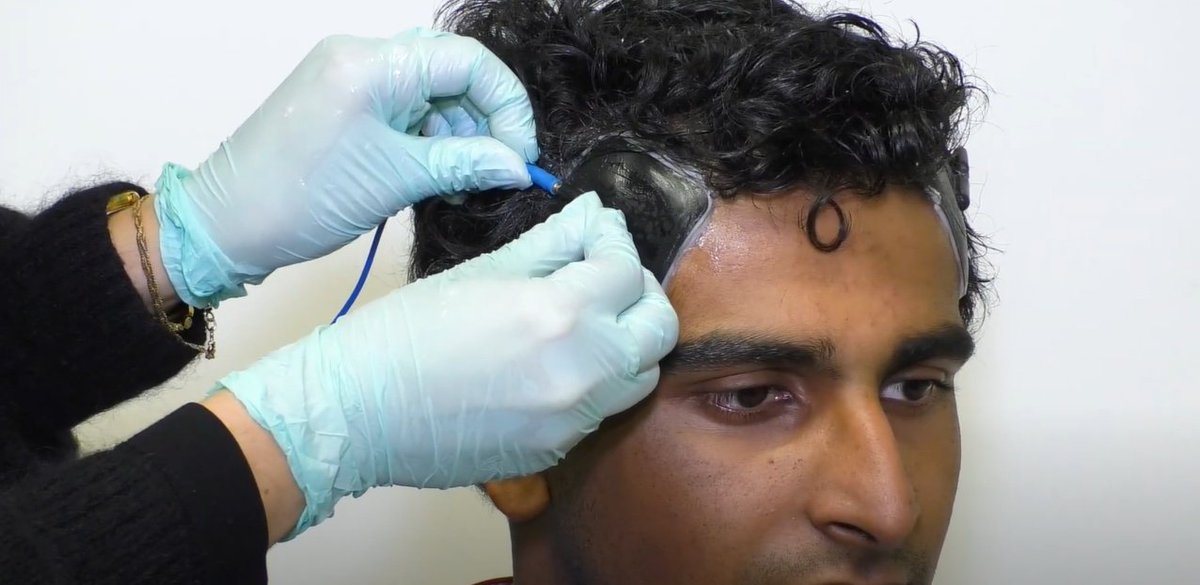 For years, the <a href="/FrohlichLab/">Frohlich Lab</a> has been developing and tweaking an innovative brain stimulation device that can help treat depression and anxiety.

Now, after clinical trials and support from the <a href="/FDA/">FDA</a>, the device is one step closer to patient use.
news.unchealthcare.org/2025/03/fda-gr…
