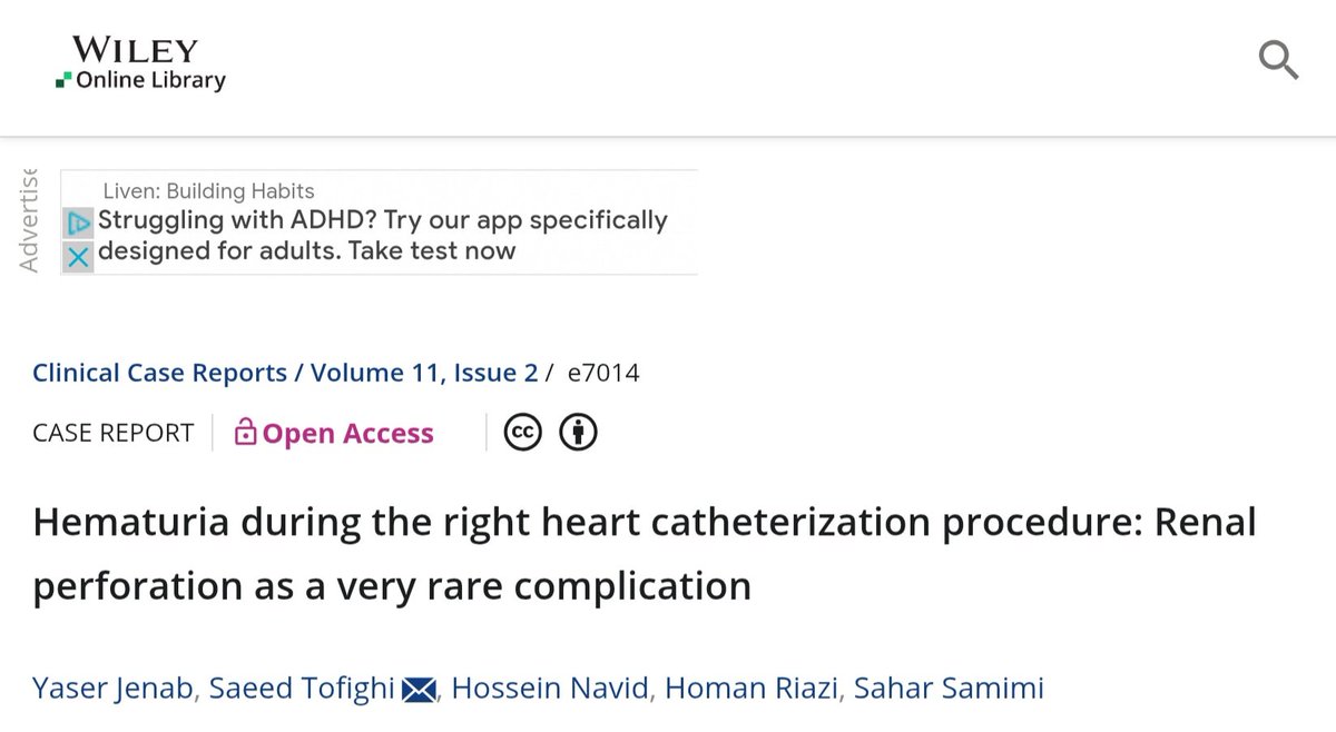 pubmed.ncbi.nlm.nih.gov/36852127

#Hematuria during right heart #Catheterization may indicate renal perforation, a rare but life-threatening complication from wire misdirection. #Venoplasty of the common iliac vein can help manage it. #RHC