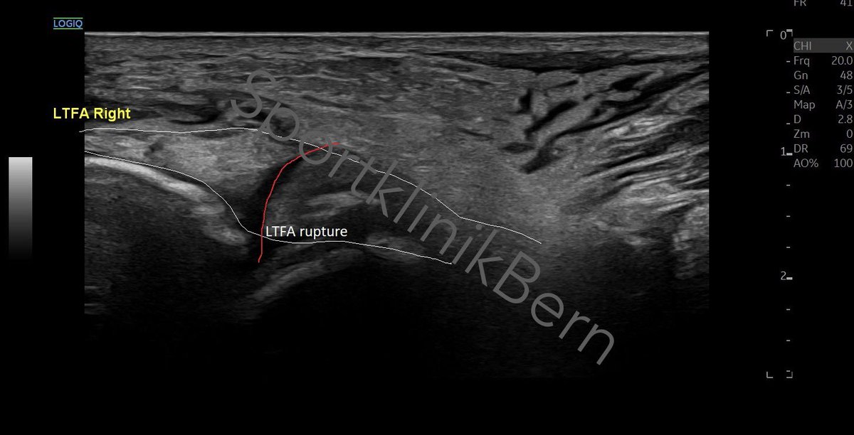 SportklinikBern's tweet photo. #ltfa rupture after ankle sprain with #functionalultrasoundimaging - #mskus #pocus #pocushub #GElogiqE10sr4 https://t.co/3MDbpwtxir