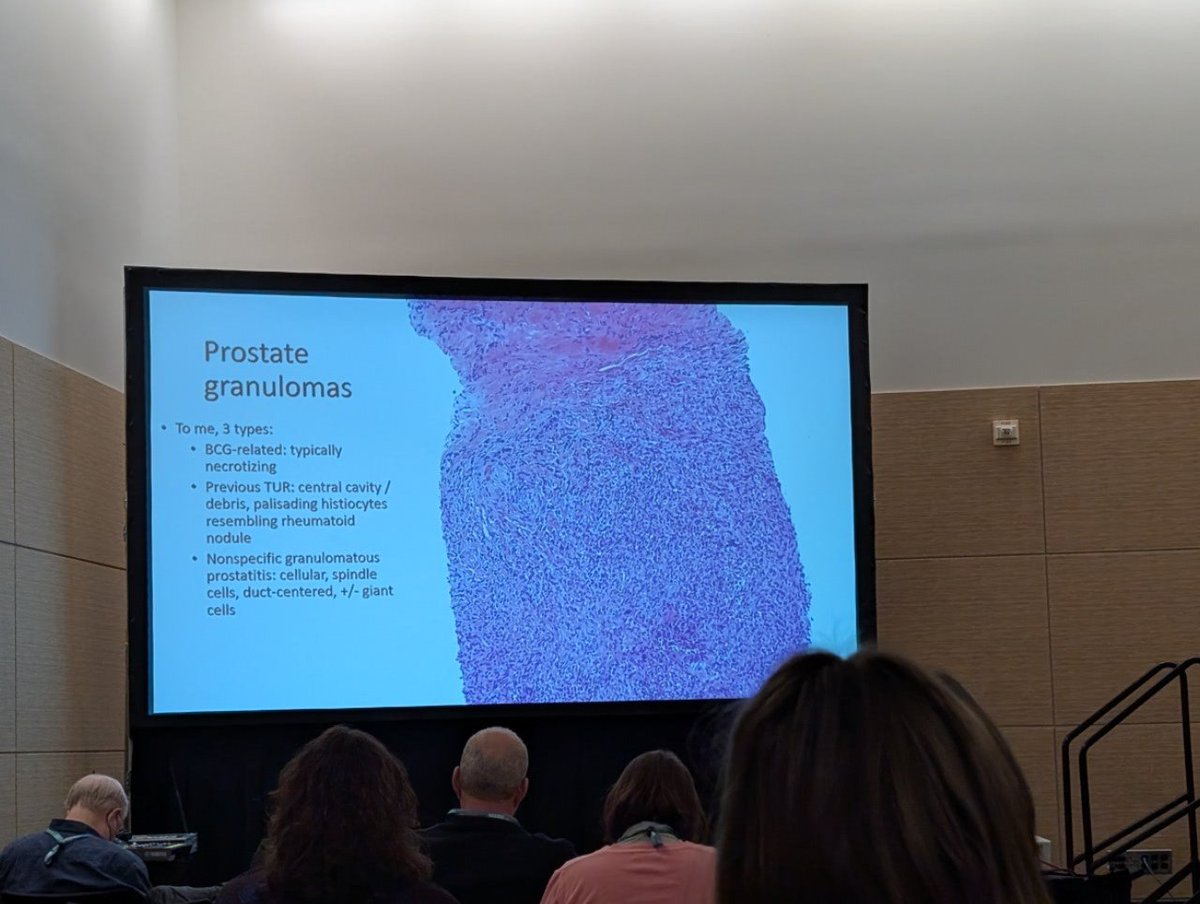 Swati Bhardwaj, MD (@drswatibhardwaj) on Twitter photo Phenomenal session by Dr. Giannico and Dr. Williamson <a href="/Williamson_SR/">Sean R Williamson MD</a> on the GU pathology no one talks about - nuanced, insightful, and packed with pearls we don’t hear often! #USCAP2025 #GUpath Phenomenal session by Dr. Giannico and Dr. Williamson <a href="/Williamson_SR/">Sean R Williamson MD</a> on the GU pathology no one talks about - nuanced, insightful, and packed with pearls we don’t hear often! #USCAP2025 #GUpath