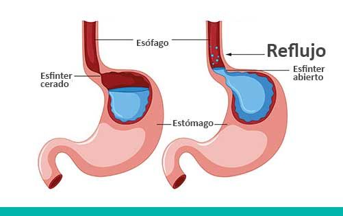 Respira_sano's tweet photo. #EscuelaApnea | ¿#SabesQue la #Apnea y el reflujo gastroesofágico frecuentemente se dan juntos? Un buen tratamiento del reflujo reduce los despertares. https://t.co/96k0byAFWs https://t.co/mY75Hk2IY2