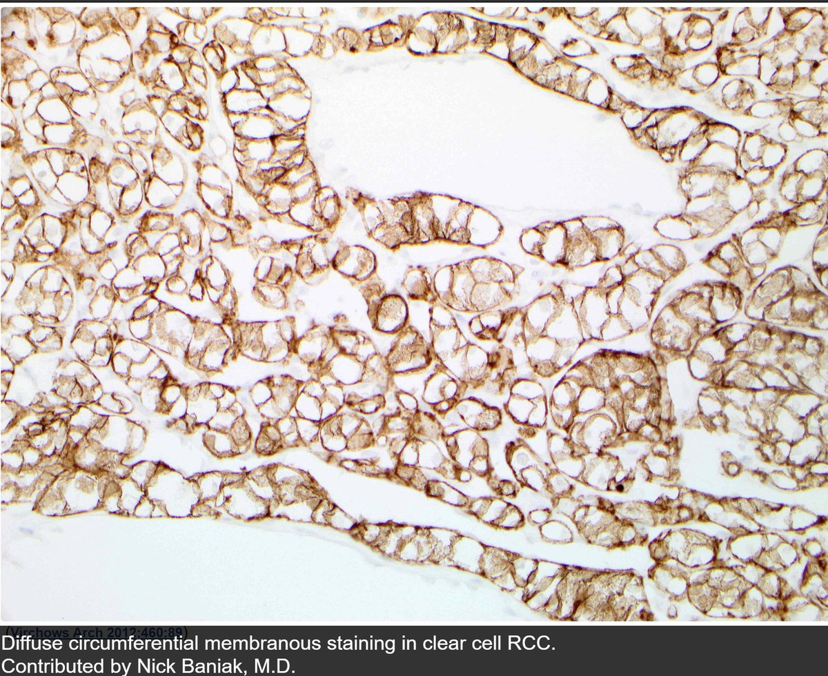 TheShorePath's tweet photo. CAIX is a membranous stain:
- Box-like/complete staining= clear cell RCC
- Cup-shaped staining= clear cell papillary RCC
- Focal (often <50%)= papillary RCC
- Negative= chromophobe RCC https://t.co/k3ay2NWyCh