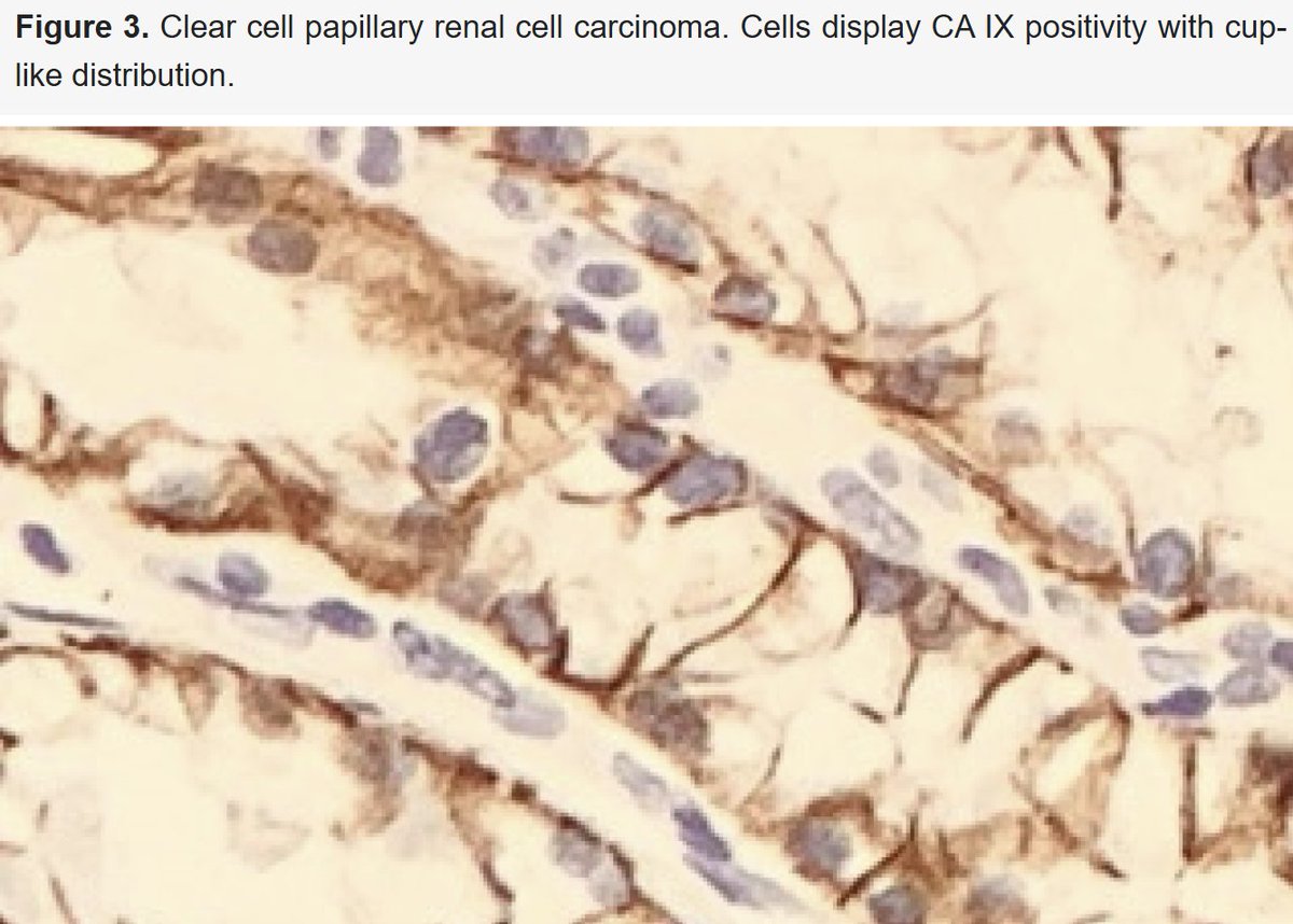 TheShorePath's tweet photo. CAIX is a membranous stain:
- Box-like/complete staining= clear cell RCC
- Cup-shaped staining= clear cell papillary RCC
- Focal (often <50%)= papillary RCC
- Negative= chromophobe RCC https://t.co/k3ay2NWyCh