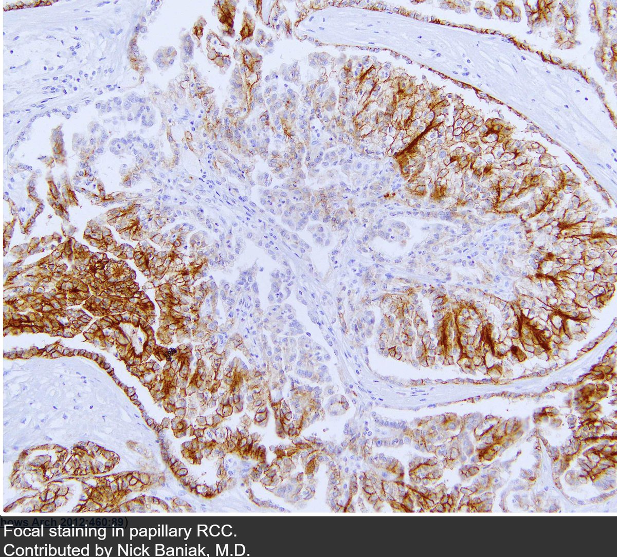 TheShorePath's tweet photo. CAIX is a membranous stain:
- Box-like/complete staining= clear cell RCC
- Cup-shaped staining= clear cell papillary RCC
- Focal (often <50%)= papillary RCC
- Negative= chromophobe RCC https://t.co/k3ay2NWyCh