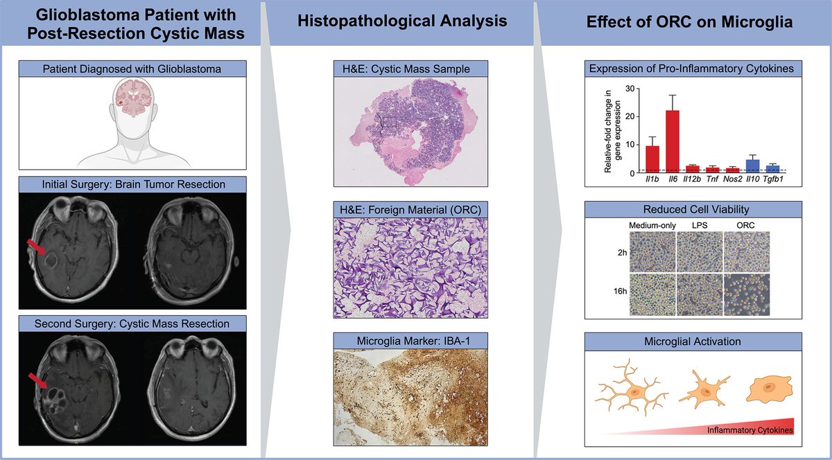 brainpathol's tweet image. Brain-derived textiloma post glioblastoma resection and application of oxidized regenerated cellulose: A pilot, bedside-to-bench, translational study
onlinelibrary.wiley.com/doi/10.1111/bp…