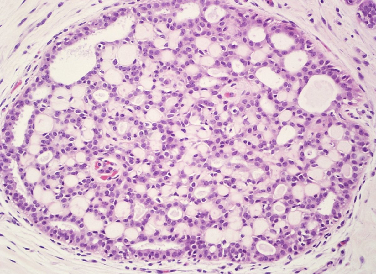 TheShorePath's tweet photo. You see these collections of spherules filled with an acellular pink material on a breast biopsy. Diagnosis?
#pathology #pathX 

@ElaineHuMD @Maicroanatomy @JuanPathMD @LordoftheSlides @GIJamesMD https://t.co/IgUAICndO3