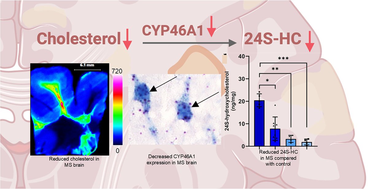 brainpathol's tweet image. Sterol imbalances and cholesterol-24-hydroxylase dysregulation is linked to the underlying progression of multiple sclerosis
onlinelibrary.wiley.com/doi/10.1111/bp…