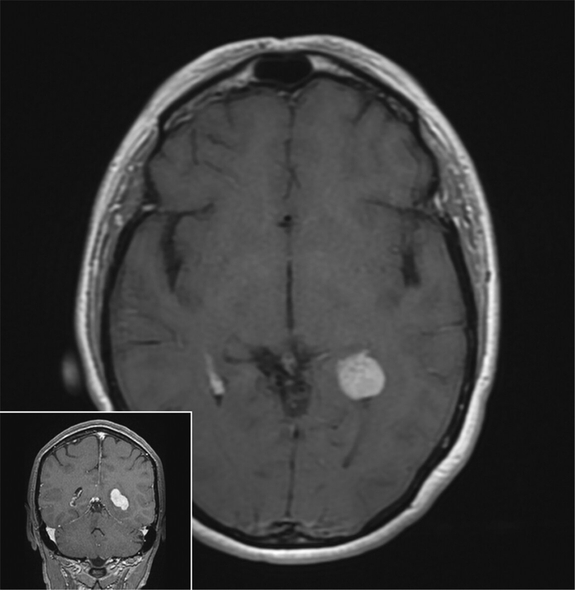 brainpathol's tweet image. Intraventricular mass in a 52-year-old woman
WHAT IS YOUR DIAGNOSIS?
WSI: isn-slidearchive.org/?col=ISN&fol=A…
Case discussion: onlinelibrary.wiley.com/doi/10.1111/bp…
#neuropath