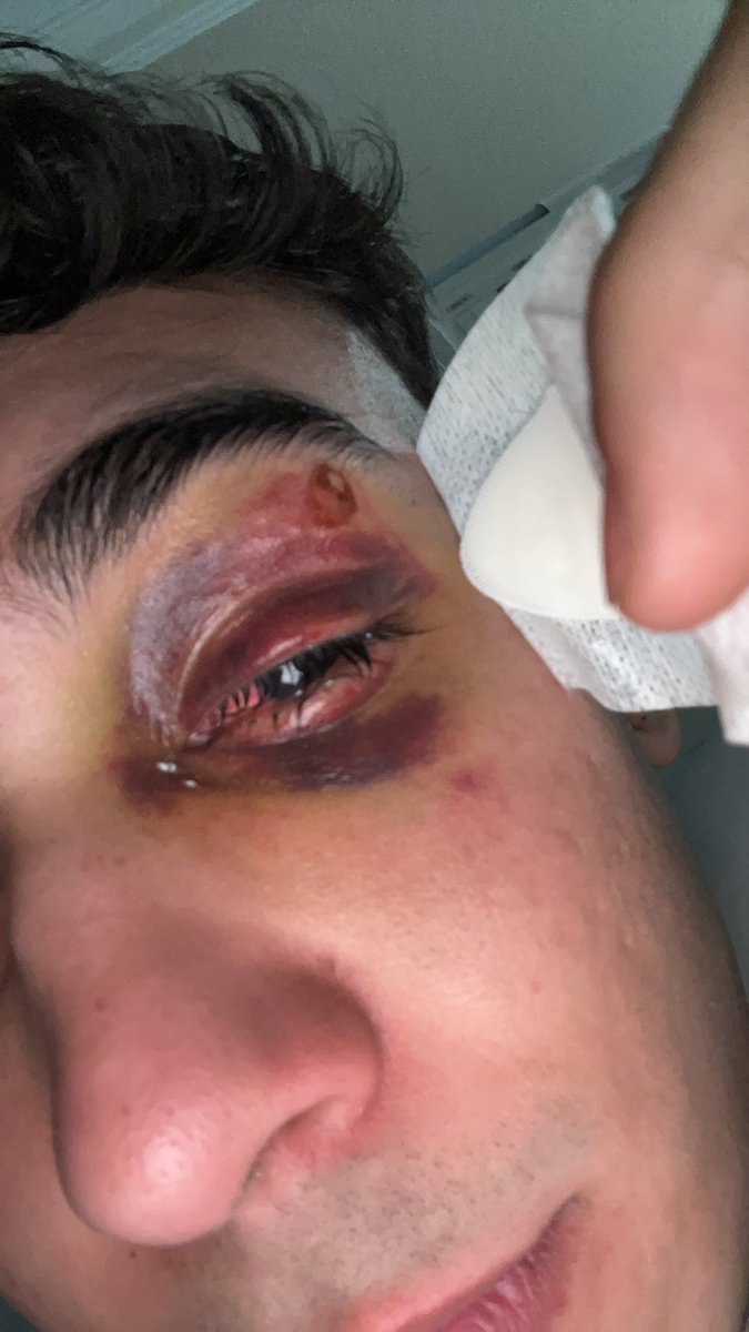 güzel insanlar selam tekrardan herkese teker teker bakamadığım için paylaşıyorum dünden bugüne büyük gelişme var el hareketlerini algılayabiliyorum sağa sola aşağı yukarı olmak üzere ve telefon flashının ışığını görebiliyorum doktorlarım IŞIK varsa UMUT var diyorlar bu süreçte