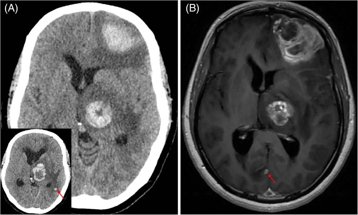 brainpathol's tweet image. Multiple intracranial hemorrhages in a postmenopausal female
WHAT IS YOUR DIAGNOSIS?
WSI: isn-slidearchive.org/?col=ISN&fol=A… and isn-slidearchive.org/?col=ISN&fol=A…
Case discussion: onlinelibrary.wiley.com/doi/10.1111/bp…
#neuropath #gynepath