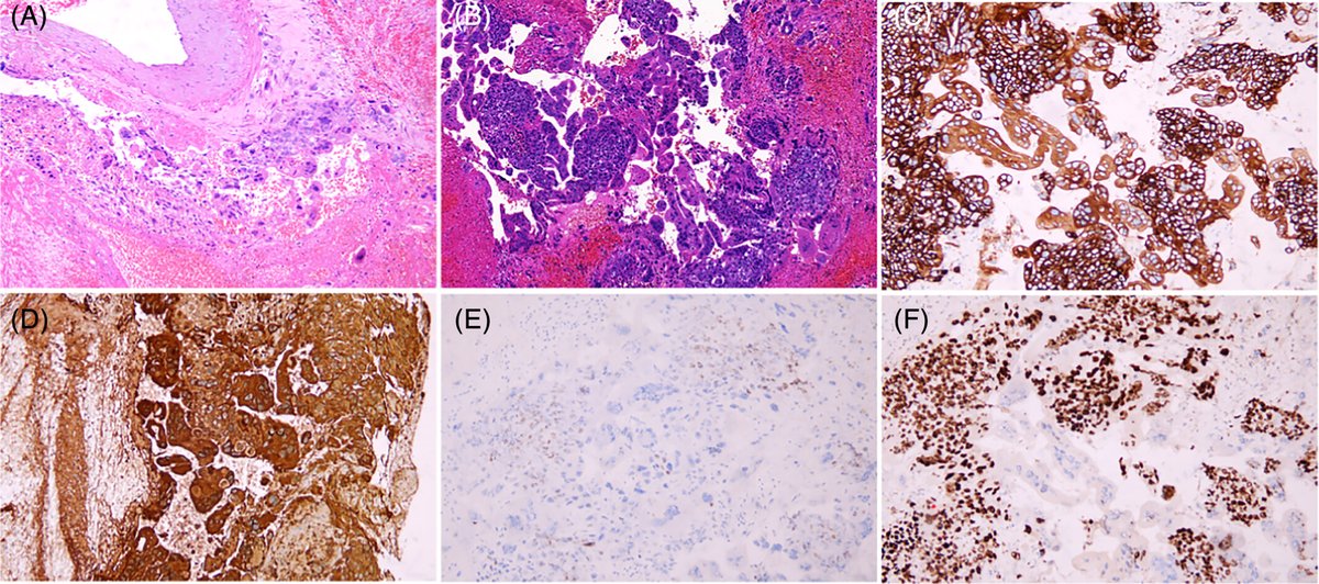 brainpathol's tweet image. Multiple intracranial hemorrhages in a postmenopausal female
WHAT IS YOUR DIAGNOSIS?
WSI: isn-slidearchive.org/?col=ISN&fol=A… and isn-slidearchive.org/?col=ISN&fol=A…
Case discussion: onlinelibrary.wiley.com/doi/10.1111/bp…
#neuropath #gynepath