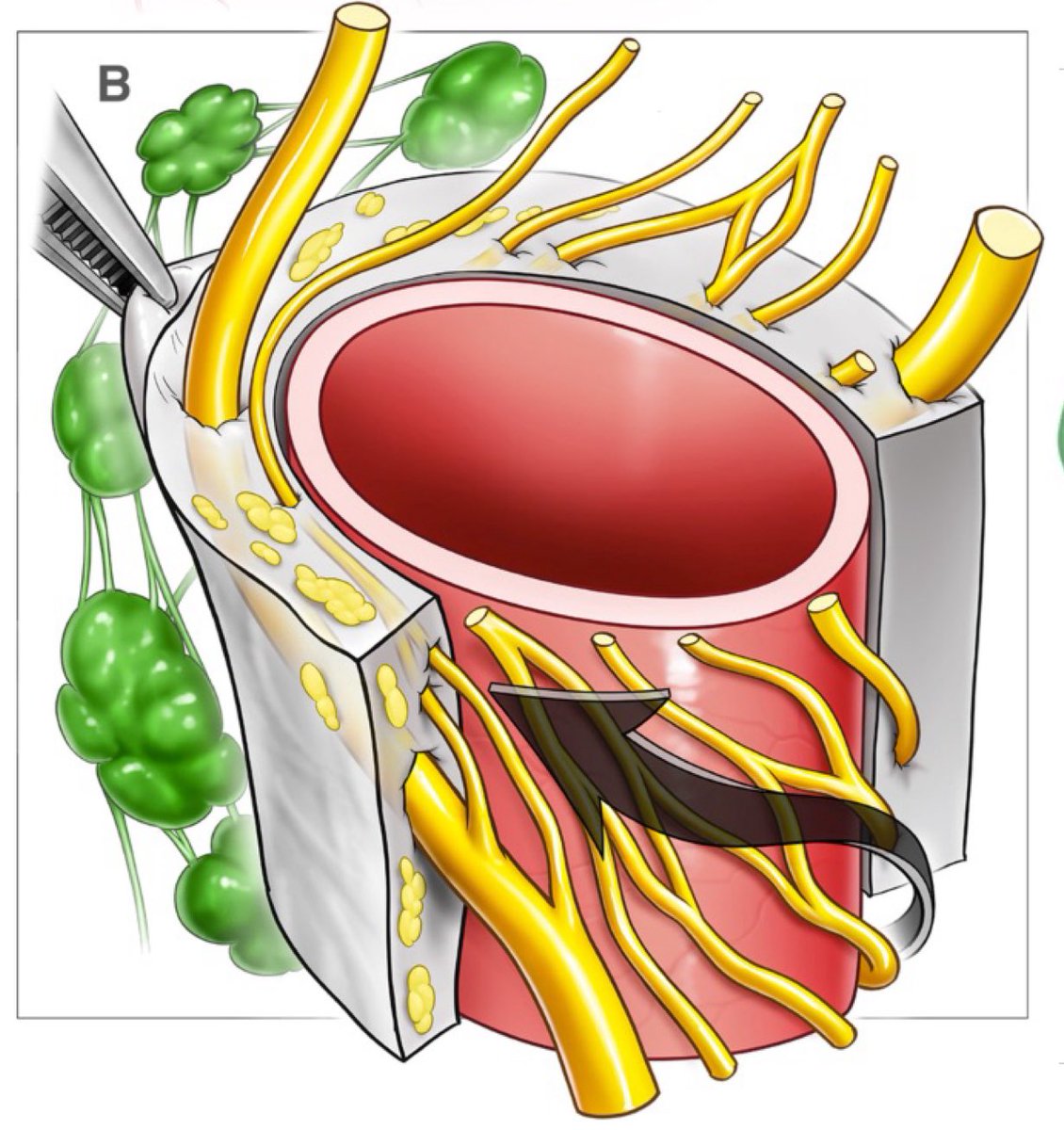 Two nerve cords frame the SMA, rotating 90° anti-clockwise with slight overlap in the peripancreatic course. A 180° clearance is needed to remove potentially affected neural tissue, spanning their full arc around the artery.
link.springer.com/article/10.100…