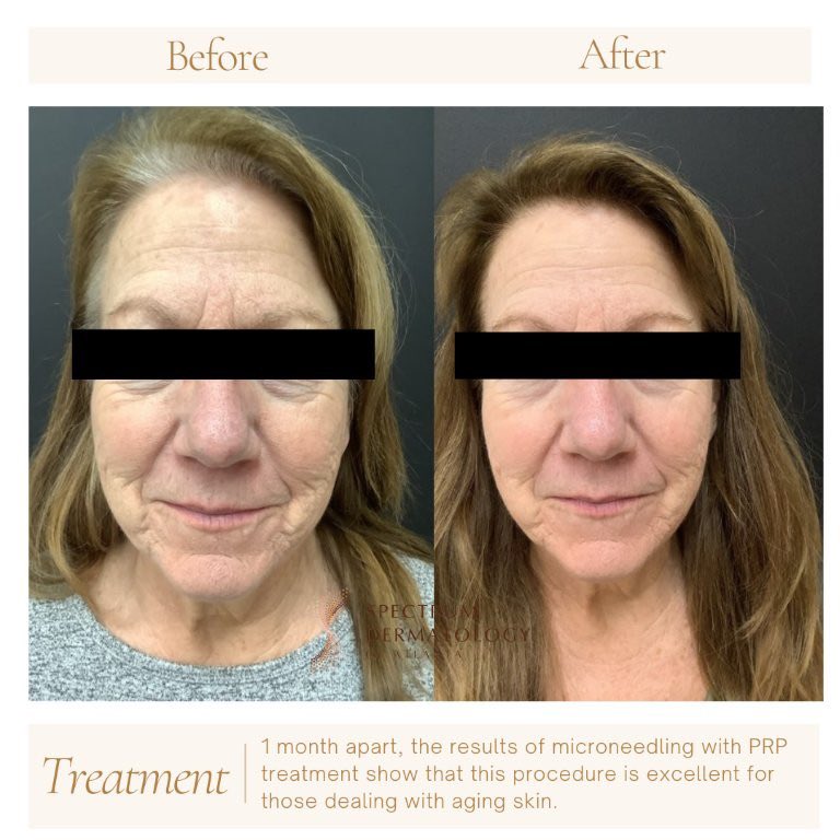 SpectrumDermATL's tweet image. Ready for a skin refresh? Microneedling is a wonderful, minimally invasive procedure that can be done in office to lift, tighten, and clarify skin, achieving a more even, youthful looking appearance.
#microneedling #selfcare #aesthetics #dermatology #skinmaintenance #skinpen