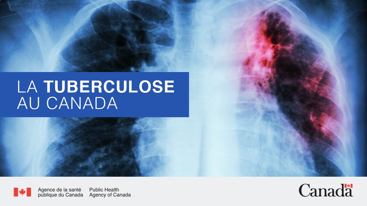 L’élimination de la tuberculose au Canada EST à notre portée si nous travaillons ensemble. Lisez notre déclaration pour la #JournéeMondialeContreLaTuberculose pour savoir comment nous travaillons avec les partenaires autochtones et gouvernementaux ow.ly/FmnC50VnC1W