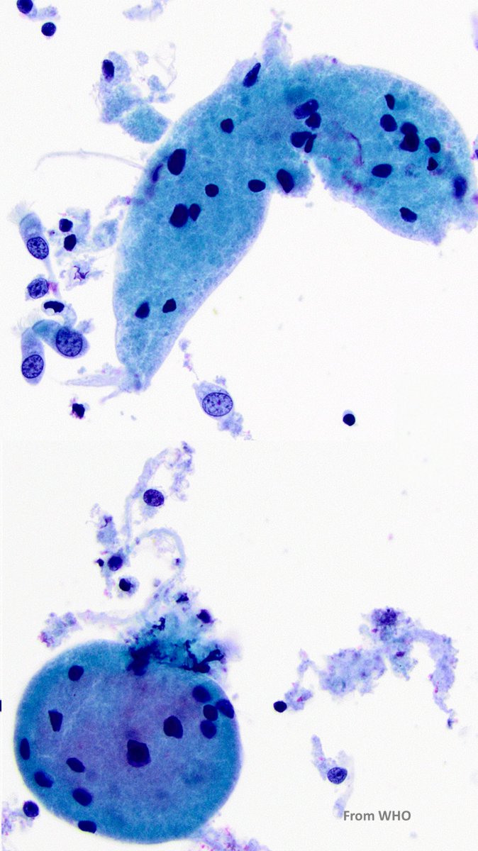 A bronchial brushing from an incidental lesion. 
What do you think the smear most likely represents?🧐🧐
A) a granulomatous process
B) a carcinoid tumor
C) a granular cell tumor
D) alveolar macrophages
#CytoPath #PathTwitter #Pathology #PulmPath