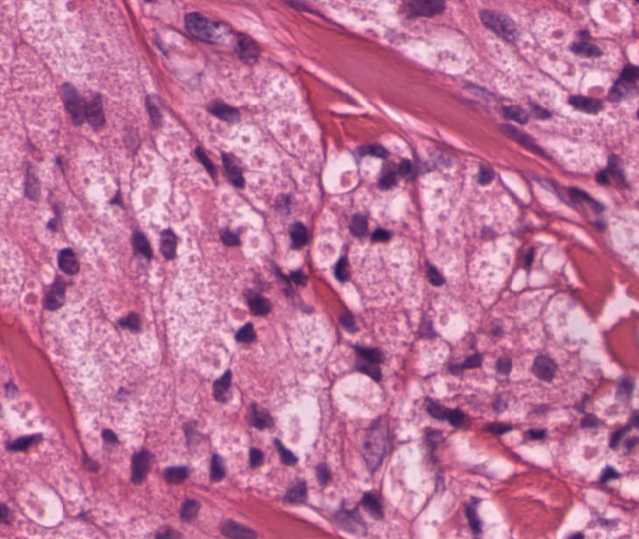 #caseoftheweek 🔬🔬🔬🔬What is causing this lesion from the skin of a 50 year old woman? S100 and PAS-D positive #dermpath #pathtwitter #pathX Full slide here: virtualpathology.leeds.ac.uk/slides/library…
