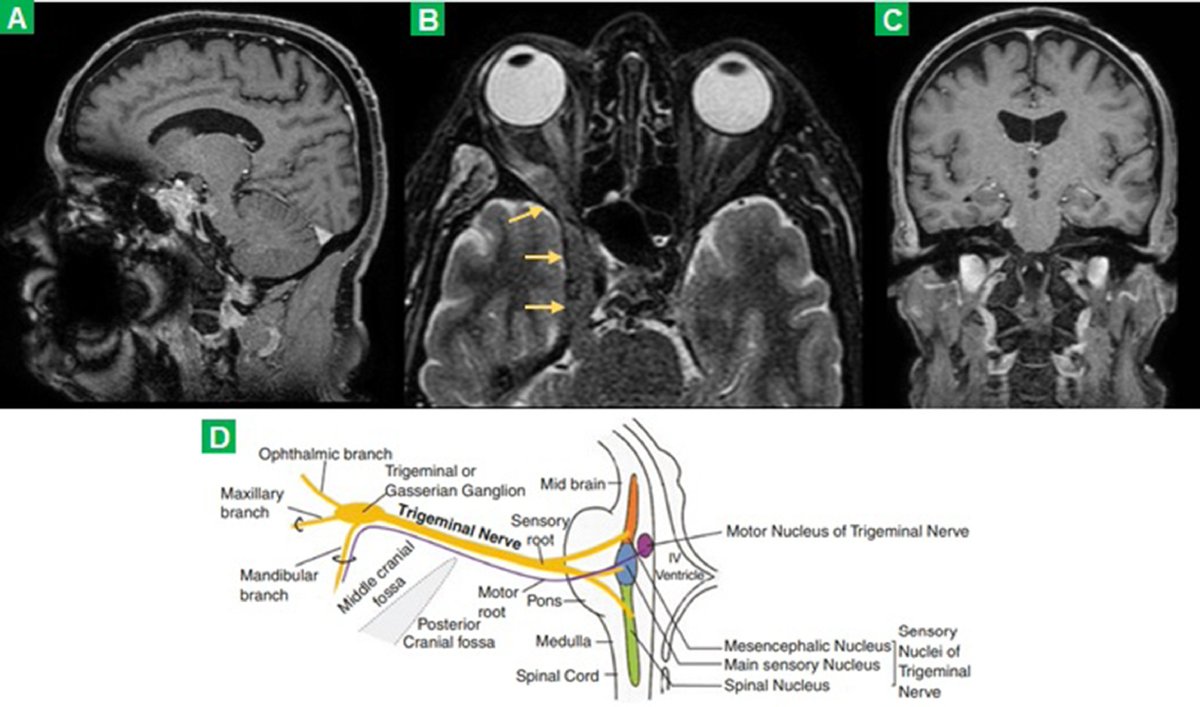 DocNavarrow's tweet photo. 👨‍🦲62M presents with progressive right-sided ptosis, ophthalmoplegia, and intense supraorbital pain unresponsive to analgesics. Months later, hypoesthesia in V1/V2 distribution appears. History of multiple facial skin tumors.

❔What could be causing his cavernous sinus syndrome? https://t.co/5mHhhSRL3I