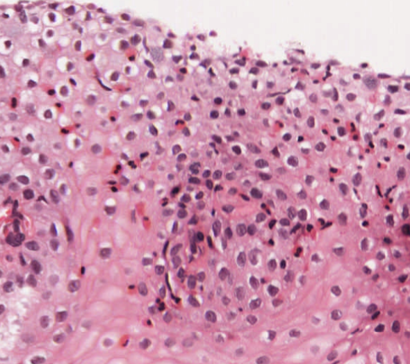 #caseoftheweek 🔬🔬🔬🔬What is causing dysphagia in this 40 year old woman? #GIpath #pathtwitter #pathX Full slide of the oesophageal biopsies here: virtualpathology.leeds.ac.uk/slides/library…