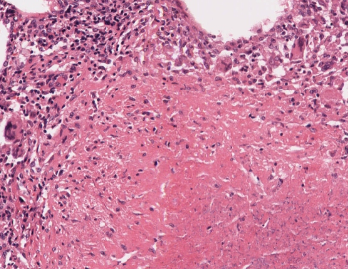 #caseoftheweek 🔬🔬🔬🔬What is causing a cough and fever in this 55 year old man?  #pathtwitter #pathX Full slide here: virtualpathology.leeds.ac.uk/slides/library…