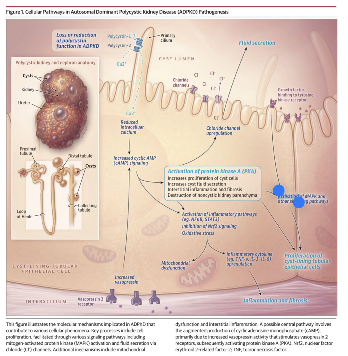 fouadchebib's tweet photo. Big day — our @JAMA_current review on ADPKD is out today! 📢 Grateful to the JAMA editorial team for their partnership in shaping this into a high-impact resource for clinicians. If you manage patients with Polycystic Kidney Disease, we hope you’ll find it valuable. https://t.co/3QstgoOn2T
@MayoClinic @MayoClinicNeph  @PKDFoundation @ndahl48 @C_HannaMD