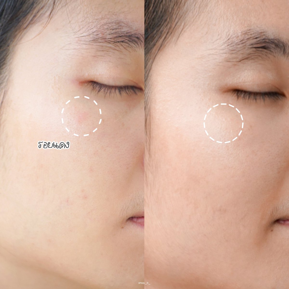 เป็นครีมที่ควรมีทุกบ้านมากๆ นี่โบก La Roche-Posay Cicaplast Baume B5+ เช้า-เย็น ​ประมาณ 3-4 วัน รอยแดงหายไปแล้ว คือหายไวแทบไม่ต้องพักหน้านาน ใครผิวแห้ง ผิวโทรม หรือแพ้อะไรมาหยิบตัวนี้มาทาได้เลยนะคับ ช่วยลดรอยแดง การอักเสบ ผิวอิ่มฟู กู้ผิวได้ดีมากจริงๆ ขออวย! 💖

#HowtoPerfect #ใช้ดีบอกต่อ #LaRochePosayTH #Cicaplast #ลาโรชโพเซย์ #ซิคาพลาส #CicaplastSPF50