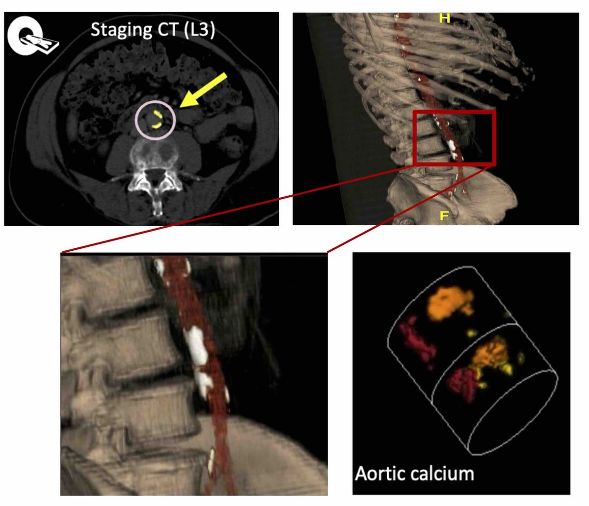 GUresearch_MCR's tweet image. @UroTaji followed up with another prize-winning 🏆 poster reporting the use of CT-derived abdominal aortic calcification to predict non-cancer mortality within the #STAMPEDE abiraterone &amp;amp; docetaxel trials