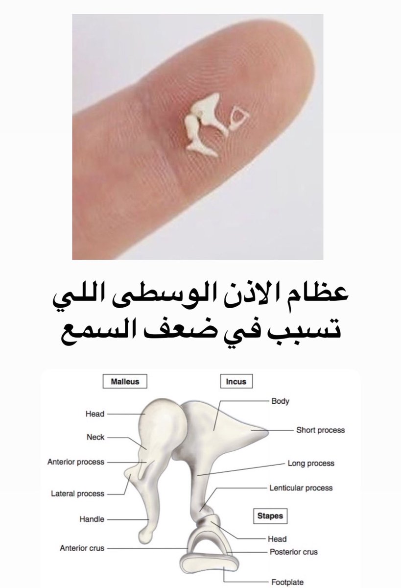 PTsmartS's tweet photo. C✅
(OI) أو العظم الزجاجي، حالة وراثية ناتجة عن خلل في الكولاجين من النوع الأول، يسبب هشاشة عظام و يؤدي لسهولة كسرها.
 يؤدي أيضًا إلى:
-ضعف السمع بسبب تأثيره على عظم الأذن الوسطى (Ossicles).
-زرقان بياض العين (Blue Sclera) لأن الصُلبة تكون رقيقة، فتظهر الأوعية الدموية من تحتها. https://t.co/82oHLNFXIN