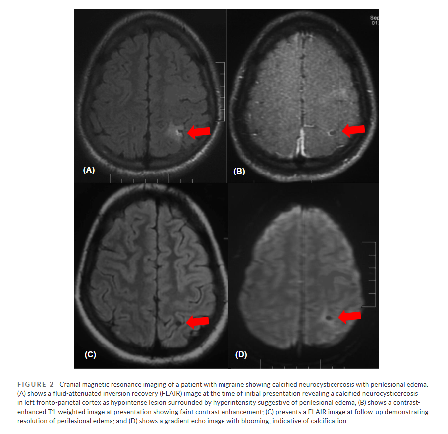 In patients with #migraine who had calcified #neurocysticercosis, a prospective study finds that presence of perilesional edema is correlated with increased migraine #headache severity
…adachejournal.onlinelibrary.wiley.com/doi/full/10.11…
Vishwesh Vishnu Naik DNB et al