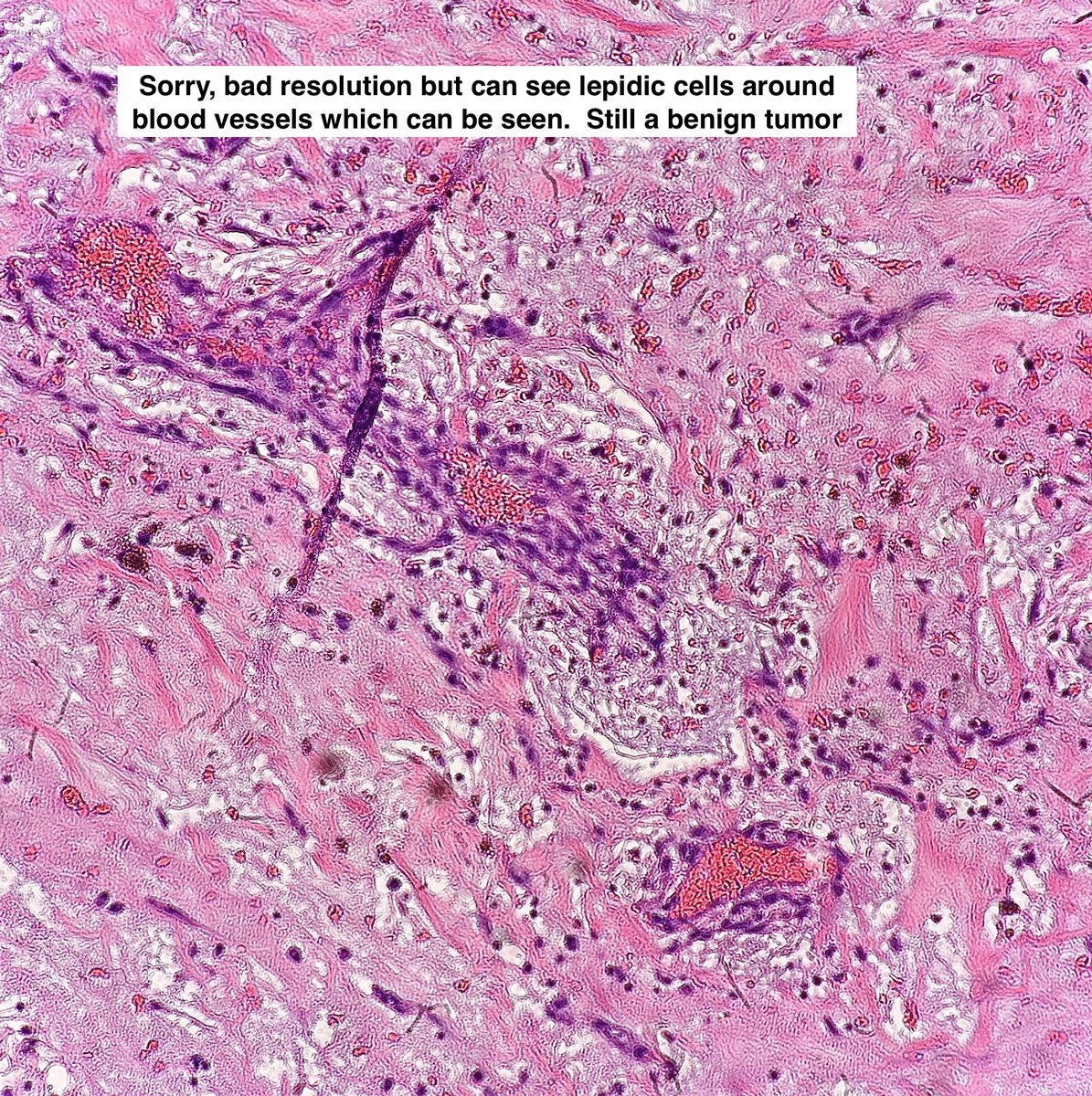 1️⃣ I am the most common 1º tumor of heart

🏠 I like to live in the left atrium.

🧬 I am associated ~10% w Carney syndrome.

🤔 Who am I?

Photo Credit: Matt Pokorney, MD

#pathx #pathology #medx #medicine