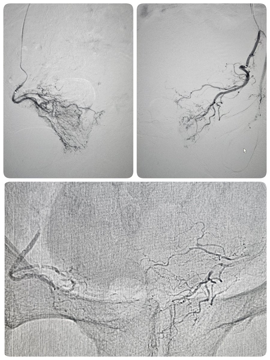 الأحدث في علاج تضخم البروستاتا الحميد بالقسطره 
إستخدام الصمغ الطبي 
(أقوى ، أسرع والأهم نسبة الرجوع أقل من الطريقه القليديه)
<a href="/Dawaliclinic1/">مركز عيادات دوالي 🥼</a> 
<a href="/bentawalah/">د محمد الطواله Altwalah</a>