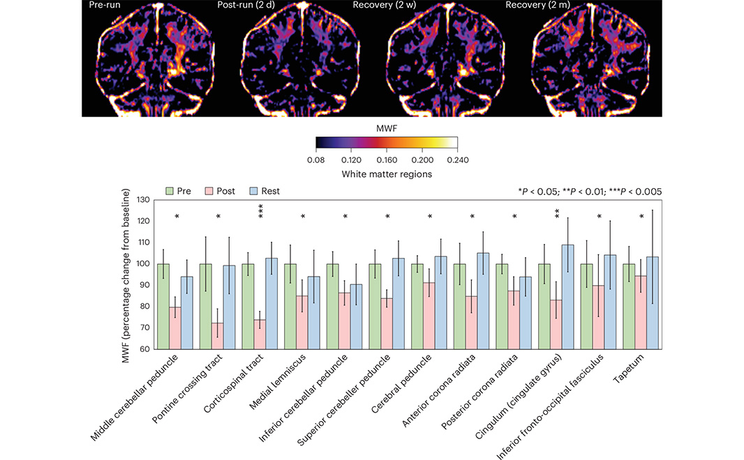 Nature Portfolio (@natureportfolio) on Twitter photo Runners appear to experience a decrease in the amount of myelin in certain regions of the brain following a marathon, according to a study of 10 participants in <a href="/NatMetabolism/">Nature Metabolism</a>. The effect, however, was completely reversed two months after the marathon. go.nature.com/4hJDCGb Runners appear to experience a decrease in the amount of myelin in certain regions of the brain following a marathon, according to a study of 10 participants in <a href="/NatMetabolism/">Nature Metabolism</a>. The effect, however, was completely reversed two months after the marathon. go.nature.com/4hJDCGb