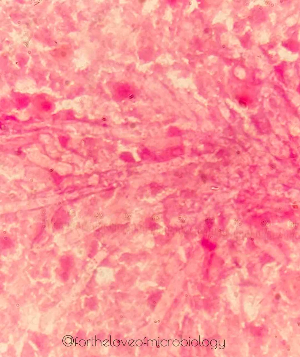 Gram stain from brain abscess shows numerous septate fungal hyphae that have not taken up  stain, appearing as refractile, ghost-like filamentous structures in the background. The hyphae are long, branching, septate, with parallel walls—features suggestive of a filamentous fungus