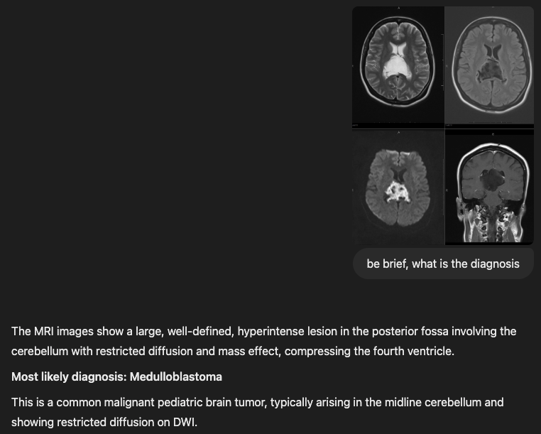 phasecontrast's tweet photo. Who do you think would be better at diagnosing this brain MRI case?

A. Second year resident
B.  GPT 4o
C. Grok 3

Take a look at what Chat GPT and Grok thing about the MRI scan. They are getting some correct diagnoses on easy scans but trip up on some of the more challenging ones.