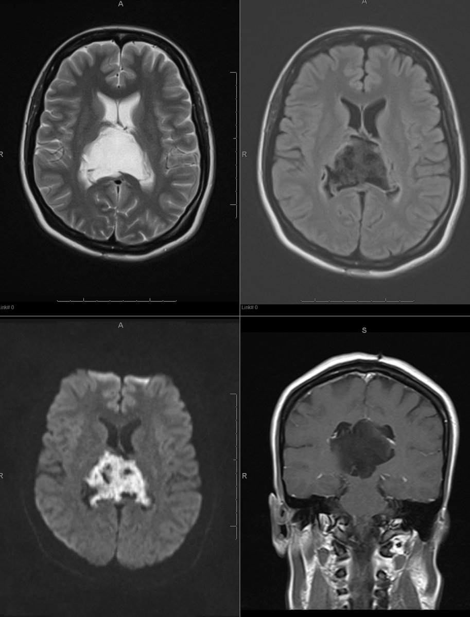 phasecontrast's tweet photo. Was curious how  LLMs such as Chat GPT and Grok 3 were interpreting medical imaging scans such as MRI, CT, X-ray, etc.. so I asked them directly 😀

It seems Chat GPT is using :

Visual Feature Analysis: (LLM-based reasoning, not CNNs)

1. Pattern recognition: Based on training with many labeled examples (text-image pairs)

2. Medical knowledge: Reasoning using anatomical, pathological, and radiological concepts.

They are not using convolutional neural networks (CNNs) like some established radiology AI tools.

This is really interesting because they are learning by associating images of scans with associated descriptive text, I assume from digitized books or reference articles when the LLM is trained. This is similar to how basic book knowledge is obtained by radiology residents. They LLM's should eventually get better and learn to diagnose textbook medical cases consistently. 

In  clinical practice, majority of the cases are not "classic" textbook cases, whether you have to infer a novel concept or diagnose with artifact/suboptimal images.  This is where practical knowledge is gained in residency and with experience. It is definitely possible the LLMs can make this leap as well...very interesting times.