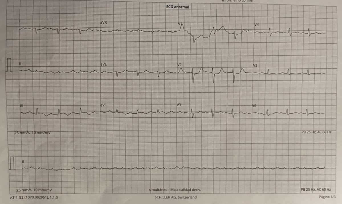 Dr. Ángel G. Nájera Albarrán (@angna_86) on Twitter photo 🧔🏾60y. epigastric pain and syncope. hemodynamic deterioration. what do you think? IMO. NOMI? Culprit? 🇲🇽 #Cardiology #EKG #MedTwitter #CardioTwitter #PCI #complexpci <a href="/mornei2011/">Neisser M</a> <a href="/BotCardiology/">Cardiology Bot</a> <a href="/EkgHacks/">ECG.Hacks</a> <a href="/smithECGBlog/">Stephen W. Smith</a> <a href="/IC_SIAC/">Intervencionismo Cardiovascular SIAC</a> <a href="/EM_RESUS/">Sam Ghali, M.D.</a> <a href="/PCRonline/">PCRonline 🫀</a> <a href="/SOCiME_/">SOCiME</a> <a href="/ecgandrhythmRoe/">Dr. Andreas Roeschl</a> 🧔🏾60y. epigastric pain and syncope. hemodynamic deterioration. what do you think? IMO. NOMI? Culprit? 🇲🇽 #Cardiology #EKG #MedTwitter #CardioTwitter #PCI #complexpci <a href="/mornei2011/">Neisser M</a> <a href="/BotCardiology/">Cardiology Bot</a> <a href="/EkgHacks/">ECG.Hacks</a> <a href="/smithECGBlog/">Stephen W. Smith</a> <a href="/IC_SIAC/">Intervencionismo Cardiovascular SIAC</a> <a href="/EM_RESUS/">Sam Ghali, M.D.</a> <a href="/PCRonline/">PCRonline 🫀</a> <a href="/SOCiME_/">SOCiME</a> <a href="/ecgandrhythmRoe/">Dr. Andreas Roeschl</a>