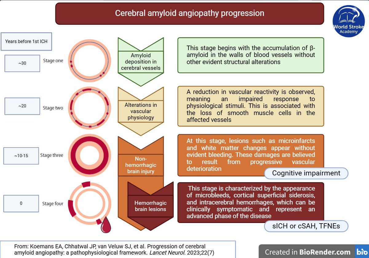 World Stroke Academy (@worldstrokeed) on Twitter photo #MondayTip
Cerebral amyloid angiopathy progression:
1🧬Amyloid deposition in cerebral vessels
2⭕️Alterations in vascular physiology
3🚫Non hemorrhagic lesions
4🩸Hemorrhagic lesions
From: doi.org/10.1016/s1474-…
<a href="/SMGreenbergNeur/">Steven M. Greenberg MD, PhD</a> <a href="/a_charidimou/">Andreas Charidimou MD, PhD</a> #MondayTip
Cerebral amyloid angiopathy progression:
1🧬Amyloid deposition in cerebral vessels
2⭕️Alterations in vascular physiology
3🚫Non hemorrhagic lesions
4🩸Hemorrhagic lesions
From: doi.org/10.1016/s1474-…
<a href="/SMGreenbergNeur/">Steven M. Greenberg MD, PhD</a> <a href="/a_charidimou/">Andreas Charidimou MD, PhD</a>