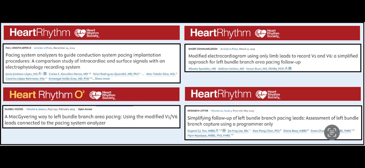 U_Arritmias_H_Mar (@arritmiashmar) on Twitter photo #Epeeps Recent evidence suggests that a simplified approach to #LBBAP
procedure/follow-up is possible, increasing the
potential for offering it anywhere and to any patient. <a href="/hrs_journal/">HeartRhythm</a> <a href="/ritmo_SEC/">Asociación del Ritmo Cardiaco</a> <a href="/HaranBurri/">Haran Burri</a> #Epeeps Recent evidence suggests that a simplified approach to #LBBAP
procedure/follow-up is possible, increasing the
potential for offering it anywhere and to any patient. <a href="/hrs_journal/">HeartRhythm</a> <a href="/ritmo_SEC/">Asociación del Ritmo Cardiaco</a> <a href="/HaranBurri/">Haran Burri</a>
