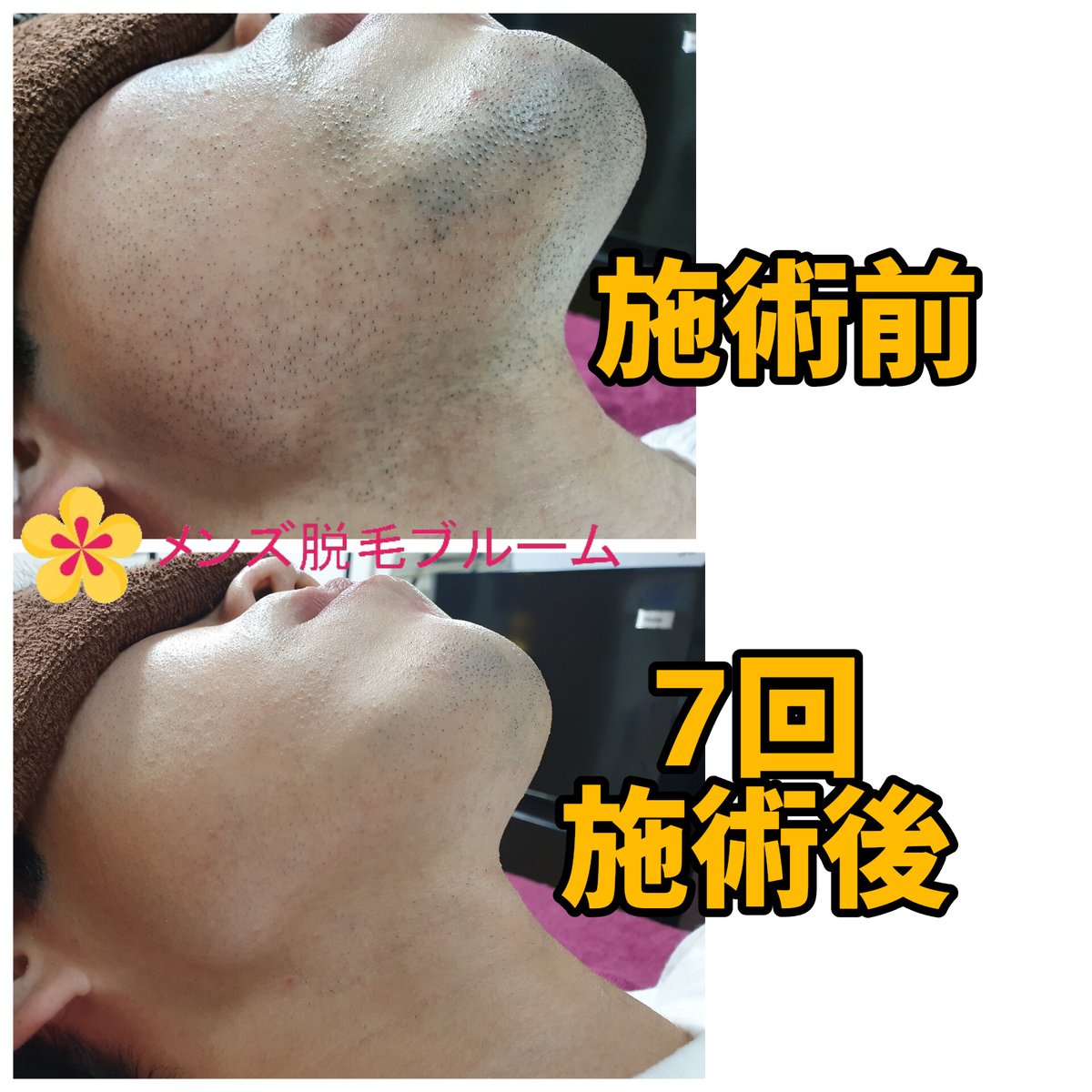 758bloom's tweet photo. 2025年4月のご新規のお客様限定のキャンペーン🔥

✨毎日のひげ剃りから解放する
ひげ脱毛初回4000円！

金山駅から徒歩3分
素早く丁寧で効果重視な施術をさせて頂きます❗

ご予約はDMかホームページからいつでもお待ちしております👌

https://t.co/vSoIbcAtuP
↑ ホームページ https://t.co/g9Qe5vOMkZ