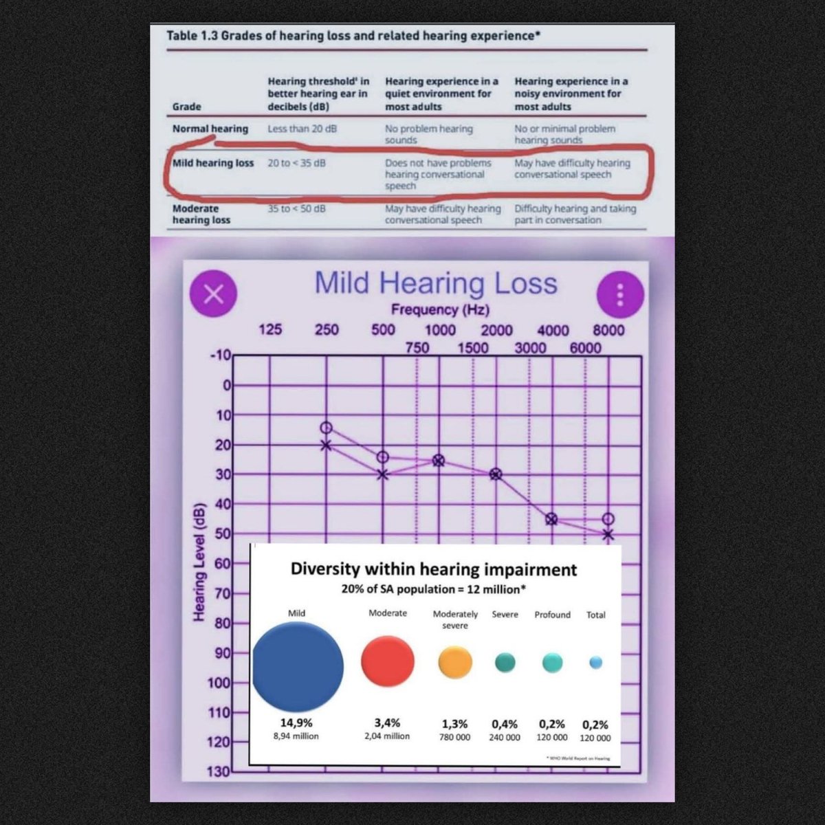 A mild hearing loss, for example, doesn't just mean sounds aren't loud enough; it also means sounds aren't clear enough. For more information, email faniedreams@gmail.com
faniedreams.co.za
ID. Extract from The World Report on Hearing 2021, Table 1.3 below.