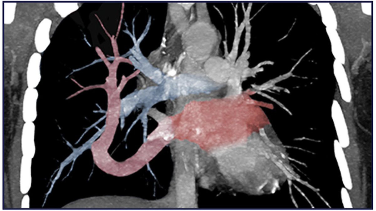 Rare case of Meandering Pulmonary Vein (MPV) diagnosed by #VIRad in a patient with suspected scimitar syndrome. 
&lt;50 MPV cases have been reported. 

Apr 2025 JVIR, Images in IR
doi.org/10.1016/j.jvir…

<a href="/JVIRmedia/">JVIR</a> <a href="/SIRspecialists/">Society of Interventional Radiology</a> <a href="/SIRRFS/">SIR RFS</a>