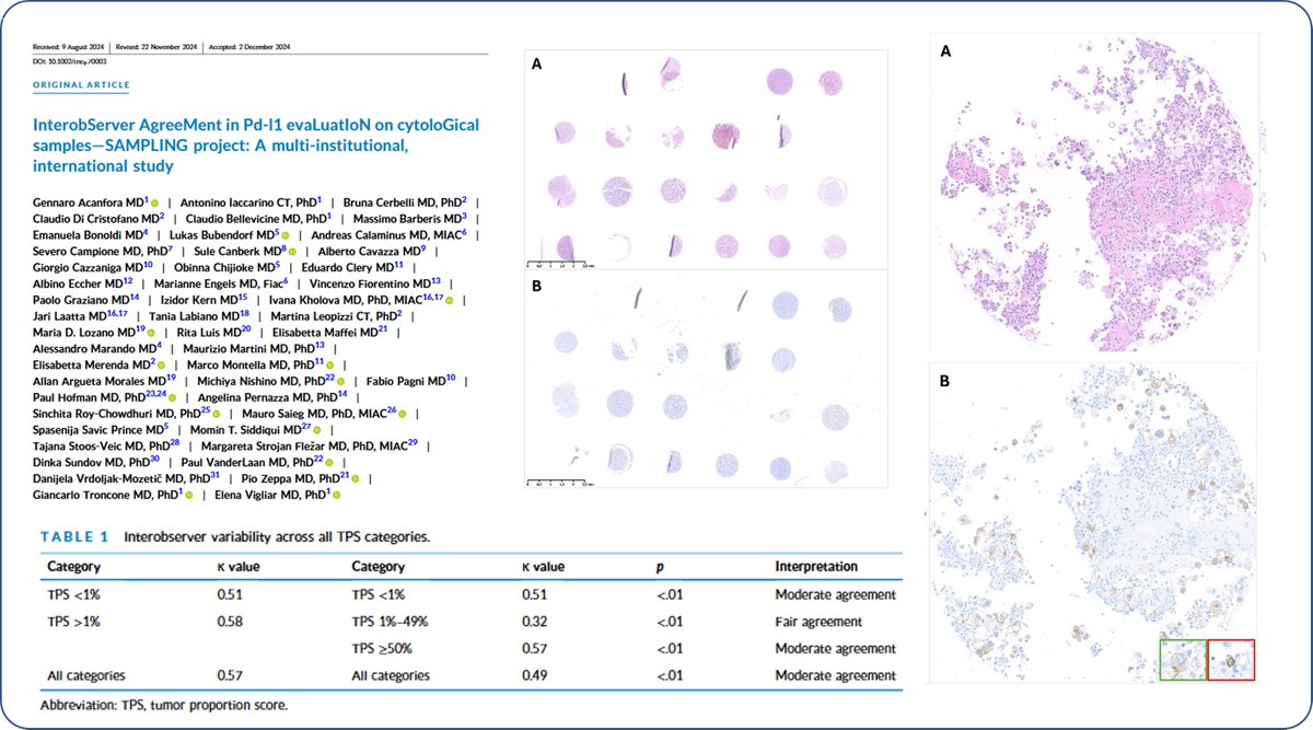 An international effort to evaluate the interobserver agreement in PD-L1 evaluation on cytological samples: the Sampling Project exploits the potential of cell block-derived TMA. acsjournals.onlinelibrary.wiley.com/doi/10.1002/cn…