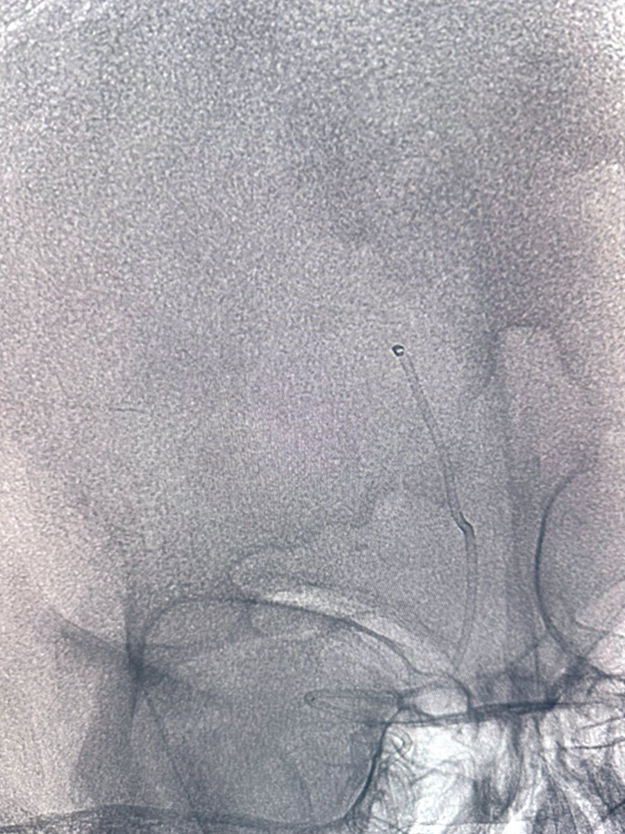 amandaebaker's tweet image. It isn’t a big tuna, but just as satisfying as a fish on a line 🎣🤌 Zoom 35 & Zoom 88 Support @Imperative_Care 🧠
(MeVO TBD but this was a high NIHSS, fresh postop 😉) @Monte_NIS @MontefioreRAD