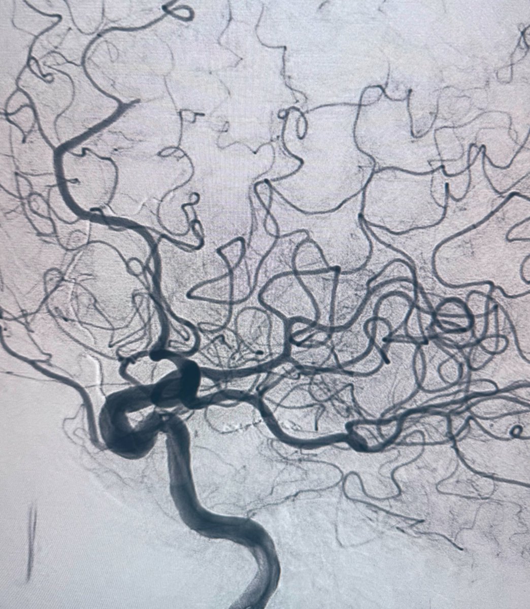 amandaebaker's tweet image. It isn’t a big tuna, but just as satisfying as a fish on a line 🎣🤌 Zoom 35 & Zoom 88 Support @Imperative_Care 🧠
(MeVO TBD but this was a high NIHSS, fresh postop 😉) @Monte_NIS @MontefioreRAD
