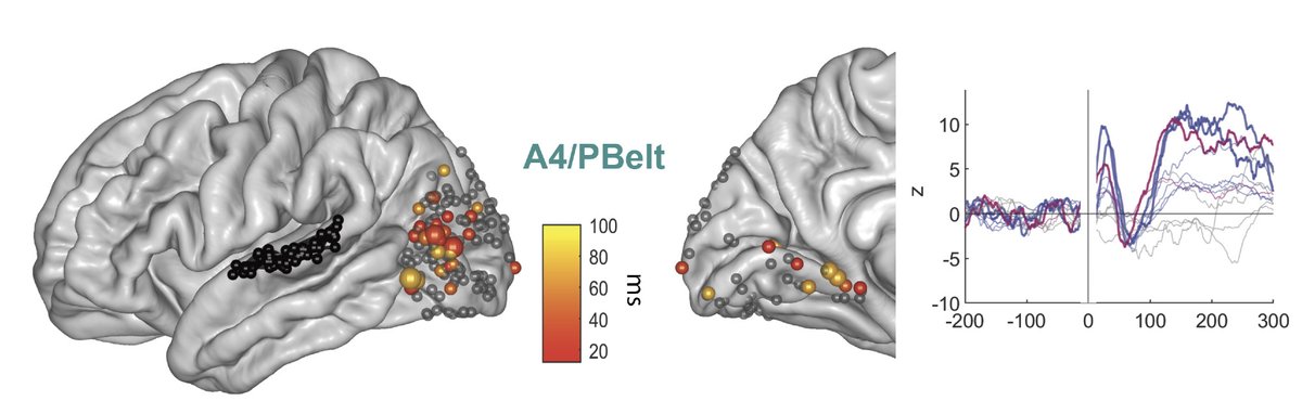 New study from the lab! We used ECoG with stimulation of the STG to test for direct (potentially monosynaptic) A-to-V connections in humans. 112 out of 231 visual electrodes (across 19/23 patients) exhibited early responses to STG stimulation (as early as 18ms after stimulation).