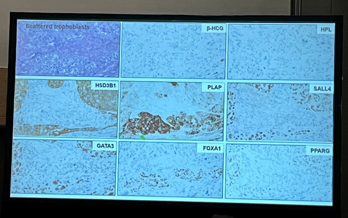 Samson W. Fine, MD (@rovingatuscap) on Twitter photo Dr Rose George continuing to present her excellent work on Molecular & IHC Features of #urothelialcarcinoma w/ Trophoblastic Differentiation at the Tuesday PM #gupath Platform Presentation session <a href="/MSKCancerCenter/">Memorial Sloan Kettering Cancer Center</a> <a href="/h_alahmadie/">Hikmat Al Ahmadie</a> Dr Rose George continuing to present her excellent work on Molecular & IHC Features of #urothelialcarcinoma w/ Trophoblastic Differentiation at the Tuesday PM #gupath Platform Presentation session <a href="/MSKCancerCenter/">Memorial Sloan Kettering Cancer Center</a> <a href="/h_alahmadie/">Hikmat Al Ahmadie</a>