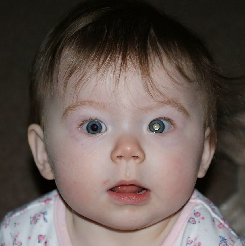 بسم الله الرحمن الرحيم،،  
ثالث ثريد لي وبيكون عن احد انواع #سرطان_العين ( Retinoblastoma )
وليش لازم الفحص الدوري الروتيني للأطفال ضروري حتى من غير أي اعراض. 
#optometry || #بصريات 👁️
 
🛑بسم الله نبدأ..