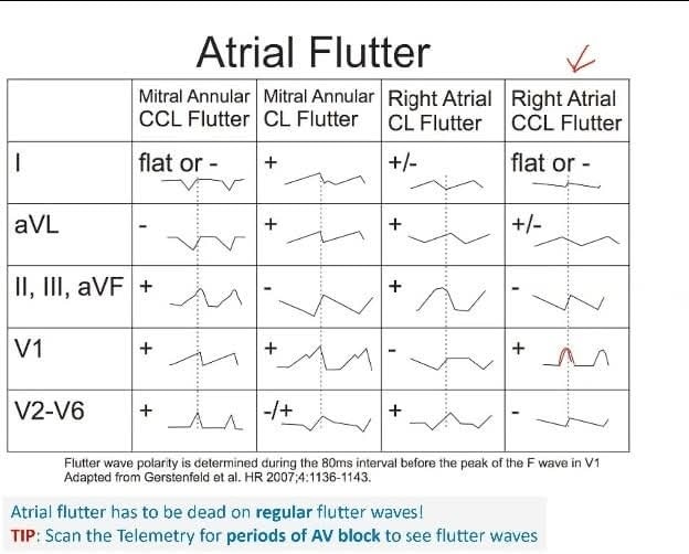 🔴Localization of Atrial Flutter (AFL) focus

 #EPeeps #MedEd #AFib #CVD #cardiology #EKG #ECG #electrocardiogram #interpretation #CardioEd #Cardiology
